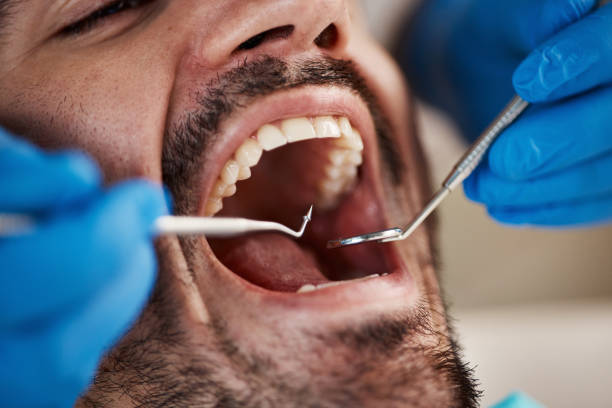 Best Broken or Chipped Tooth Repair in Start, LA