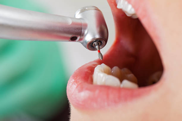 Best Emergency Root Canal Therapy in Start, LA